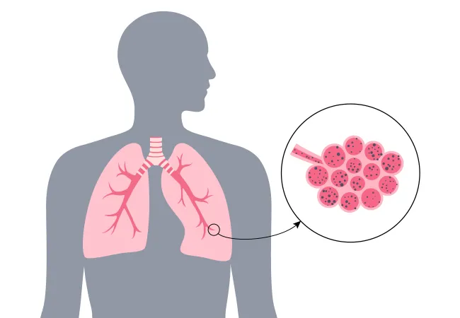 inalazione polveri alluminio